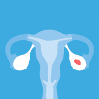 Ovarian Cancer