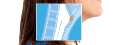 Head and neck cancer