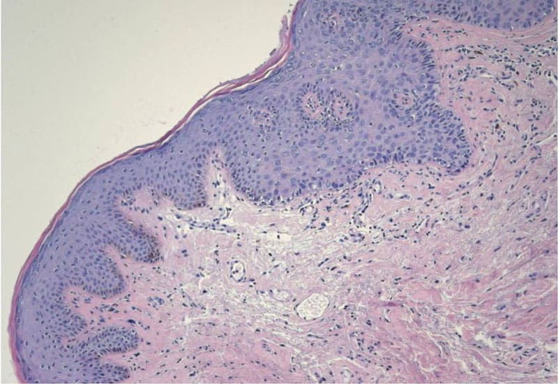 VIN lesion post-vaccination. Image courtesy of Dr. Cornelis Melief.